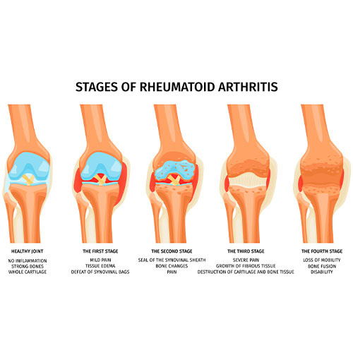 best arthritis Treatment